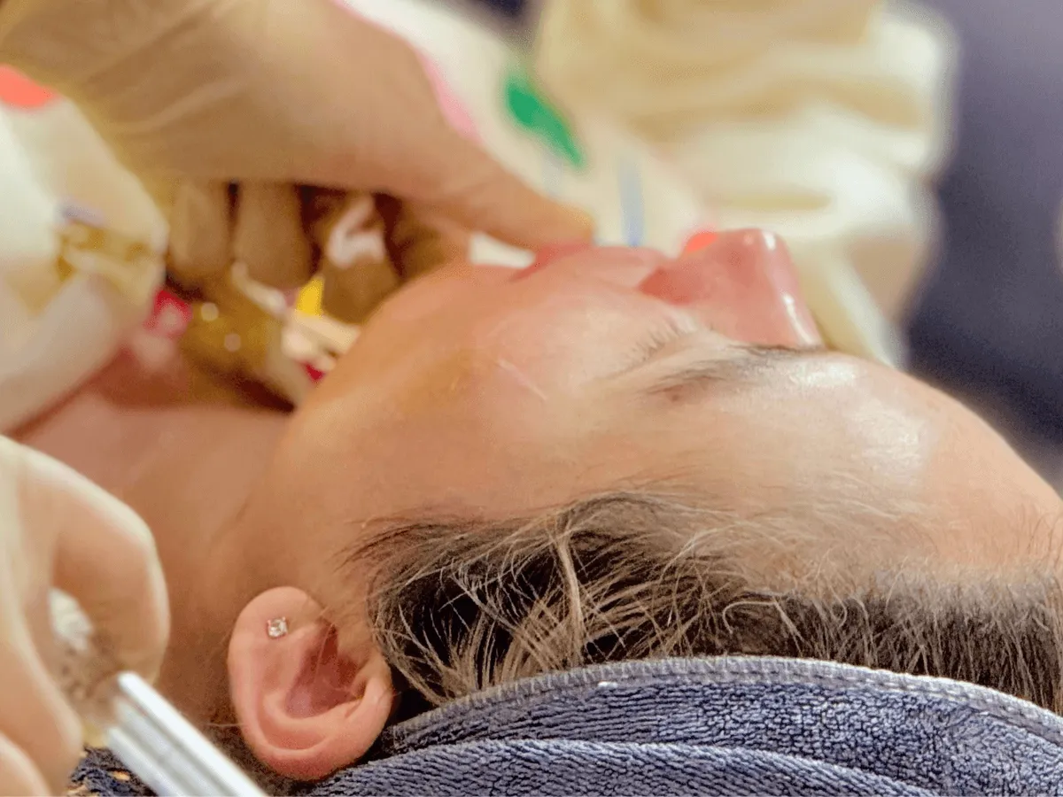 Meso Thon Gọn Hàm